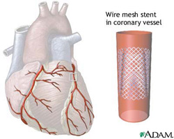Wire mesh stent in coronary vessel